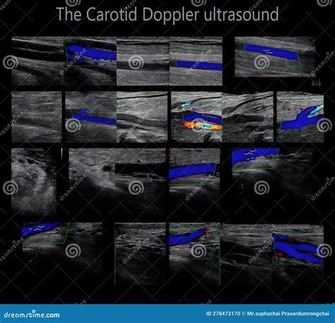 Cta Brachial Artery Or Ct Scan Vessel Of Upper Extremity Stock Image