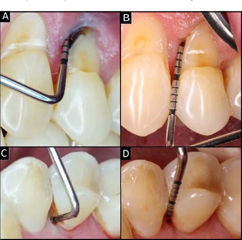 Figure From Treatment Of Endo Periodontal Lesion Using Leukocyte