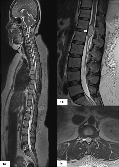 Figure 1 From Chronic Intramedullary Spinal Cord Abscess Mimicking