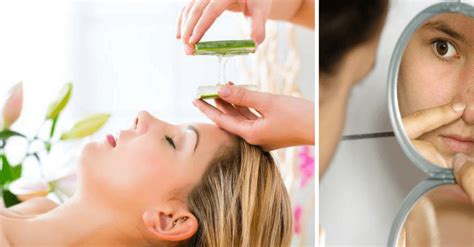 Combate Verrugas Manchas Y Espinillas Con Productos Naturales