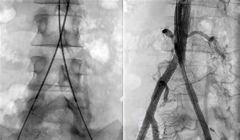 A Stent Reconstruction With Standard Nitinol Stents In Kissing