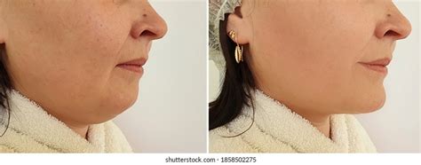 Woman Double Chin Before After Treatment Stock Photo 1858502275 ...