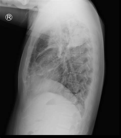 Severe Lobar Pneumonia Complicated By Hydropneumothorax Image