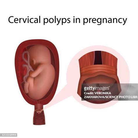 Cervical Polyps Photos and Premium High Res Pictures - Getty Images