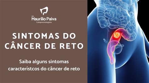 Sintomas Do C Ncer De Reto Cancerdeintestino Cancerdereto