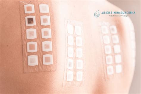 Teste De Contato Ou Patch Test Saiba Como Feito E Quais Os Tipos