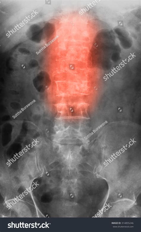 X-Ray Image Of Burst Fracture L1-L3 Vertebrae, Ap View Stock Photo ...