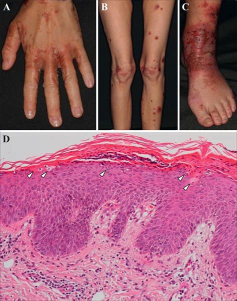 Necrolytic Migratory Erythema Face