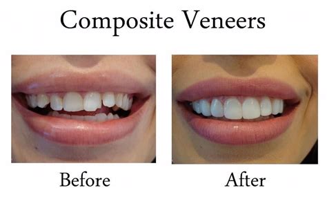 Composite Veneers — best dental clinic in dublin