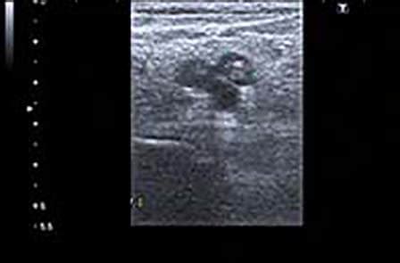 Ultrasound Guided Peripheral IV Insertion - NurseAvatar