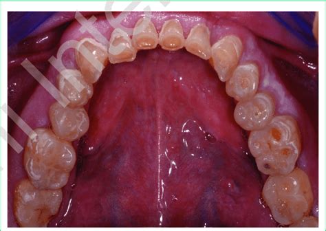 Lingual View Of The Tooth Wear Download Scientific Diagram