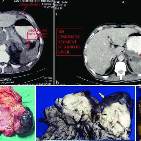 A Cect Abdomen And Pelvis Showing Nodular Enhancing Lesions In The Download Scientific