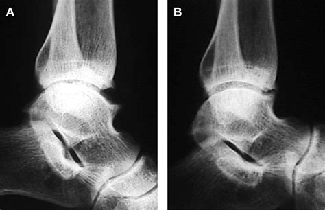 Anterior And Posterior Ankle Impingement Syndromes Foot And Ankle Clinics