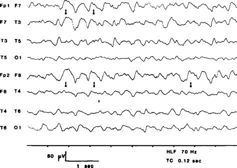 Periodic Eeg Patterns In Cerebral Fat Embolism Semantic Scholar