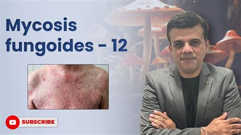 Histology Of Mycosis Fungoides Vs S Zary Syndrome Key Features