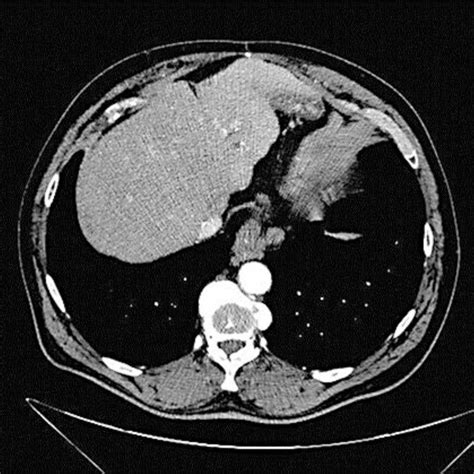 CT Scan 1 Year After SBRT Showing Complete Remission Of The Treated