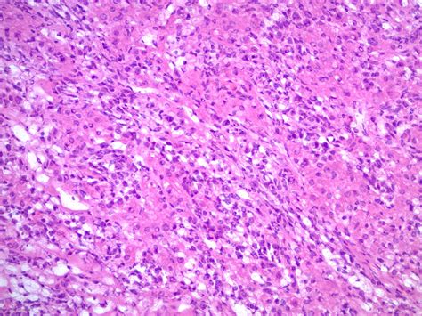 Pathology Outlines Sertoli Leydig Cell Tumor