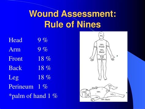 Rule Of Nines Burn Formula