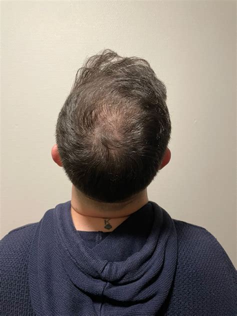 Grafts Fue Months Before After Results Smile Hair Clinic