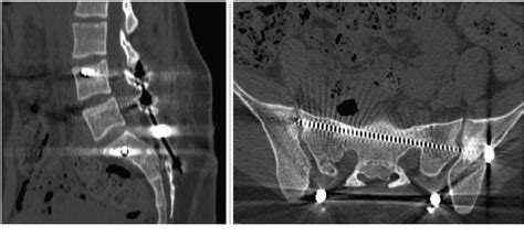 Figure 1 From Management Of A Rare Case Of Isolated U Shaped Displaced Sacral Fracture In A