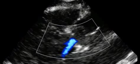 Ultrasound Of Aortic Dissection Recapem