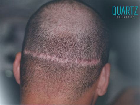 Hair Transplant Scar Quartz Hair