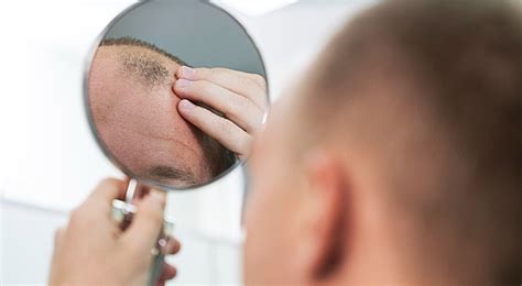 Voici Pourquoi De Nombreux Hommes Perdent Leurs Cheveux Et Deviennent