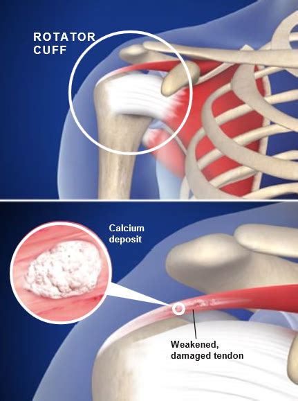 Calcific Tendinitis Of The Shoulder Central Coast Orthopedic Medical