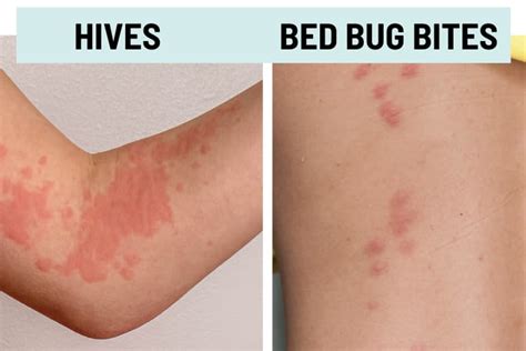 Bed Bug Bites Vs Hives Understanding The Differences Houston Bed