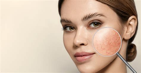 Acne Vs Rosacea Whats The Difference Charette Cosmetics