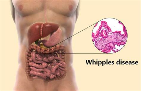 Whipple’s Disease Symptoms, Causes, and Treatments – New Life Ticket