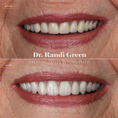 High Quality Cosmetic Dentures With Dr Green Springfield Smile Doctor