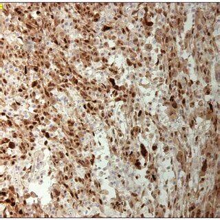 Histology of a lipoma-like well-differentiated liposarcoma (hematoxylin ...