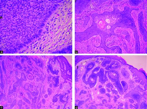 Adenoid Basal Cell Carcinoma Histology