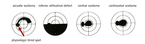 differential diagnosis  visual impairment stroke manual