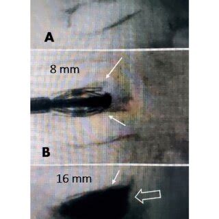 Intra-operative expansion of a vertebral plana A: Severe central... | Download Scientific Diagram