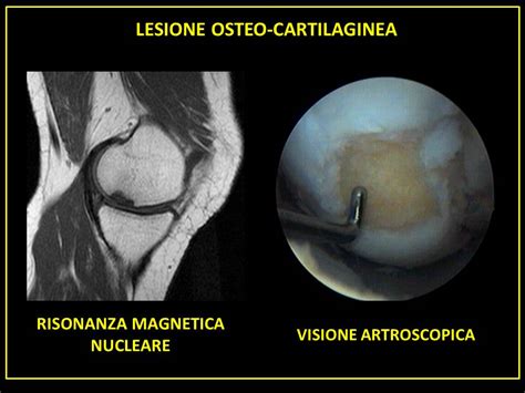 Medicina Ecco Come Curare L Artrosi Con L Utilizzo Delle Cellule Staminali