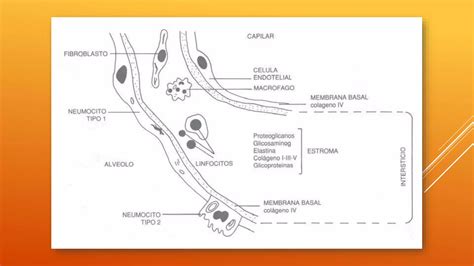 Enfermedades Pulmonares Intersticiales Ppt