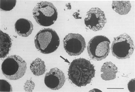 Characteristic Ultrastructure Features Of Apoptosis In B Cll Cells