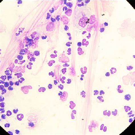 Cytology Of Peritoneal Fluid A Few Active Neutrophils Several Download Scientific Diagram