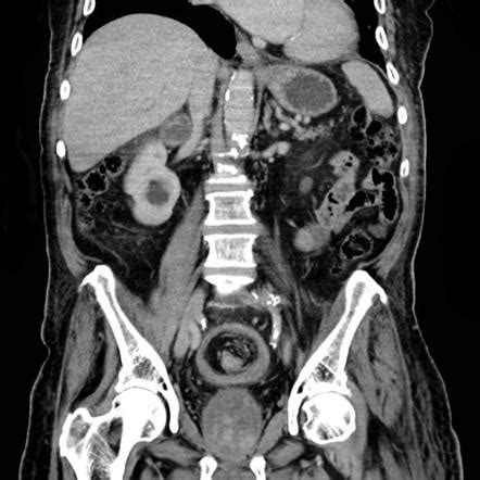 Colorectal Intussusception Radiology Case Radiopaedia Org