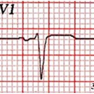 V1 lead of a healthy patient with normal left atrial size for... | Download Scientific Diagram