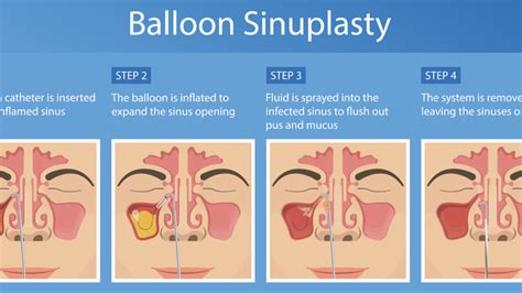 What Is Balloon Sinuplasty Aesc