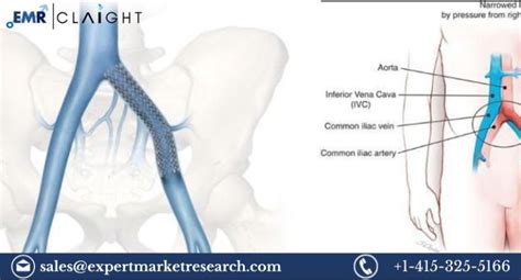 Venous Stents Market Size Share Price Trends Growth