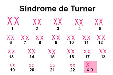 S Ndrome De Turner O Que Causas E Tratamento Hot Sex Picture Hot Sex