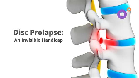 Disc Prolapse Causes Symptoms And Solutions