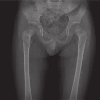 Radiological view of coxa vara deformity. | Download Scientific Diagram