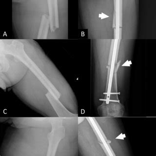 A A Preoperative Plain Film Of A Transverse Femoral Shaft Fracture B A