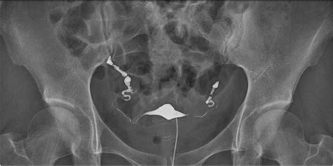 X-ray Image Of Normal Hysterosalpingography (HSG) Stock, 44% OFF