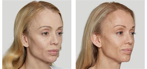 Dermal Fillers Nyc Facial Fillers New York City